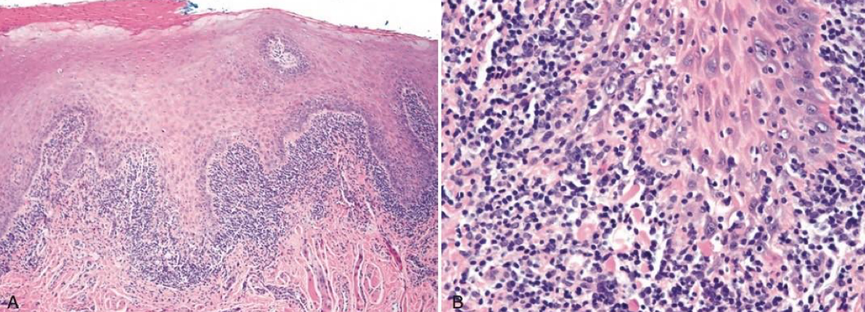 <p>which autoimmune/immune-mediated/allergic lesion: T cell mediated basal cell destruction; blue band lymphocytes; stellate looking on edges bc keratin layer acanthosis </p>
