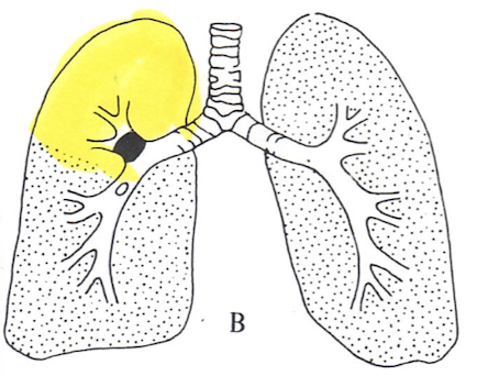 <p>Diagnosis?</p><p>Ventilation study ABNORMAL</p>