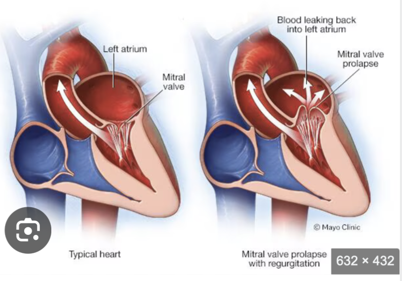 <p>What Happens in Mitral Valve Prolapse?</p><p>Normally:</p><ul><li><p>During systole (ventricular contraction)</p></li><li><p>The mitral valve closes tightly</p></li><li><p>Blood moves forward into the aorta</p></li></ul><p>In MVP:</p><p>The valve cusps <strong>bulge (billow) upward into the left atrium during systole</strong></p><p>Because they do not close tightly:</p><ul><li><p>Blood may leak backward into the LA</p></li><li><p>This can cause <strong>mitral regurgitation</strong></p></li></ul><p></p>