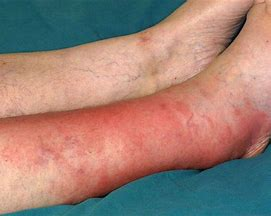 <ol><li><p><span style="color: #f31bac"><strong>Tenderness/ Inflammation</strong></span></p></li><li><p><span style="color: #d450e8"><strong>Skin sore</strong> or <strong>rash </strong>spreading quickly</span></p></li><li><p><span style="color: #0ebadc"><strong>Tight, glossy</strong></span> skin</p></li><li><p><span style="color: #16c90d"><strong>Abscess/pus</strong> formation</span></p></li><li><p><span style="color: #7764ed"><strong>Fever</strong>, elevated <strong>WBCs</strong></span><strong> </strong>(infx)</p></li></ol><p></p>