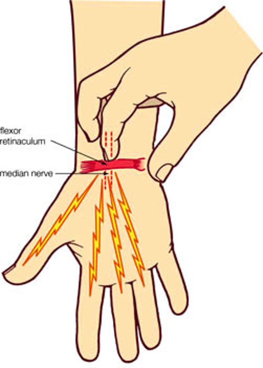 <p>Percuss over the flexor retinaculum (anterior portion of the wrist where a watch would sit) and the Tunnel of Guyon (most medial portion of above)</p><p>Postive: Tingling in the lateral 3 fingers (Carpal Tunnel Syndrome) of medial two fingers (Ulnar Impingement)</p>