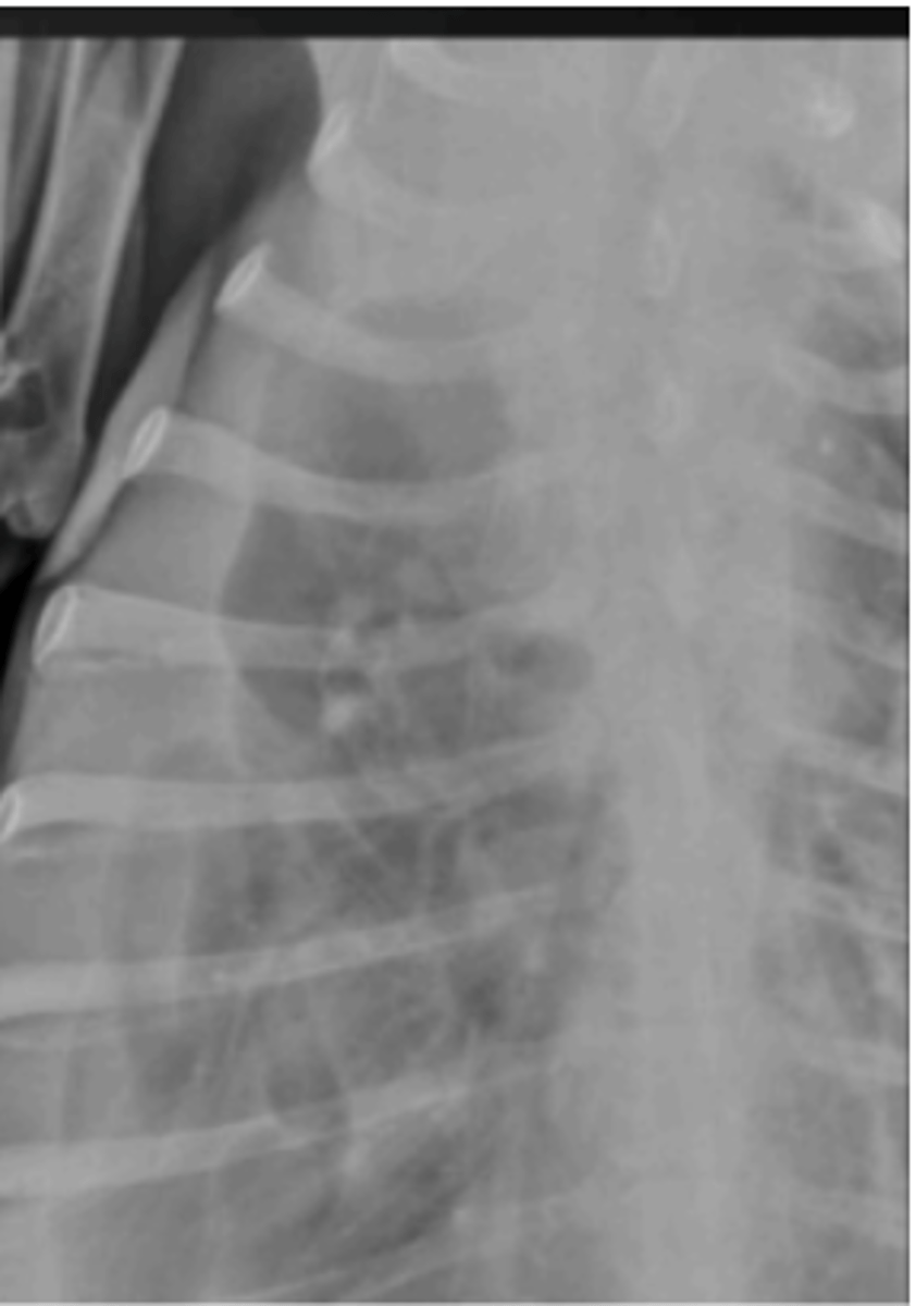 <p>Image where it's hard to see heart; what is the principle finding?</p>