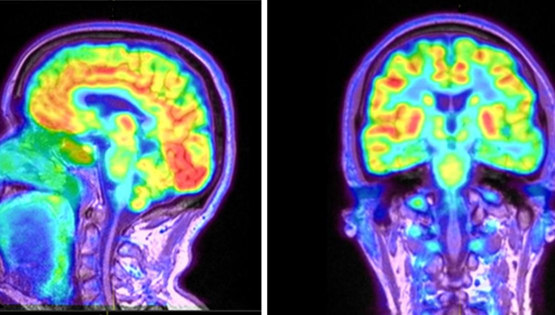 <p>Brain-imaging method where<strong> radioactive suga</strong>r is injected into a subject and a computer compiles a <strong>color-coded image of activity </strong>in the brain with lighter colors indicating more activity. Shows what part of the brain is NOT functioning.</p>