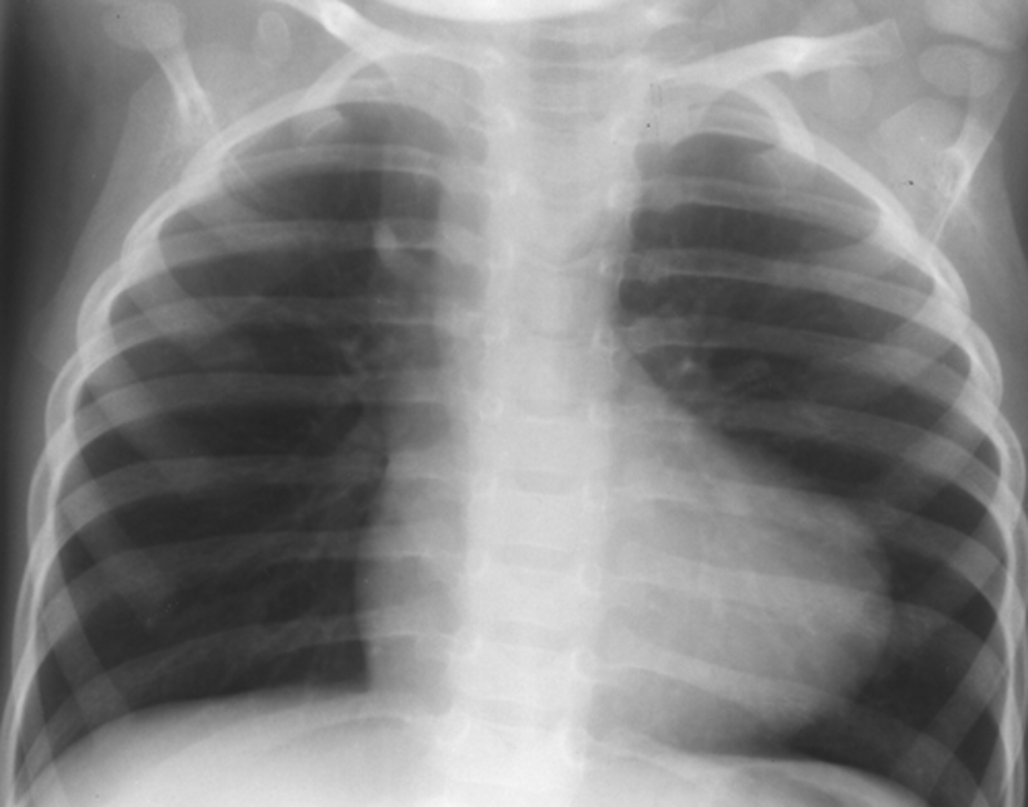 <p>right to left</p><p>1. VSD</p><p>2. R ventricular hypertrophy</p><p>3. overriding aorta</p><p>4. pulmonic stenosis (RV outflow obstruction)</p><p>(photo: boot-shaped heart)</p>