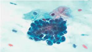 <p>Cellules endométriales chez patiente de plus de 45 ans </p><p>1) comment rapporter </p><p>2) différentiel </p><p>3) clé diagnostique</p><p>4) conduite</p>