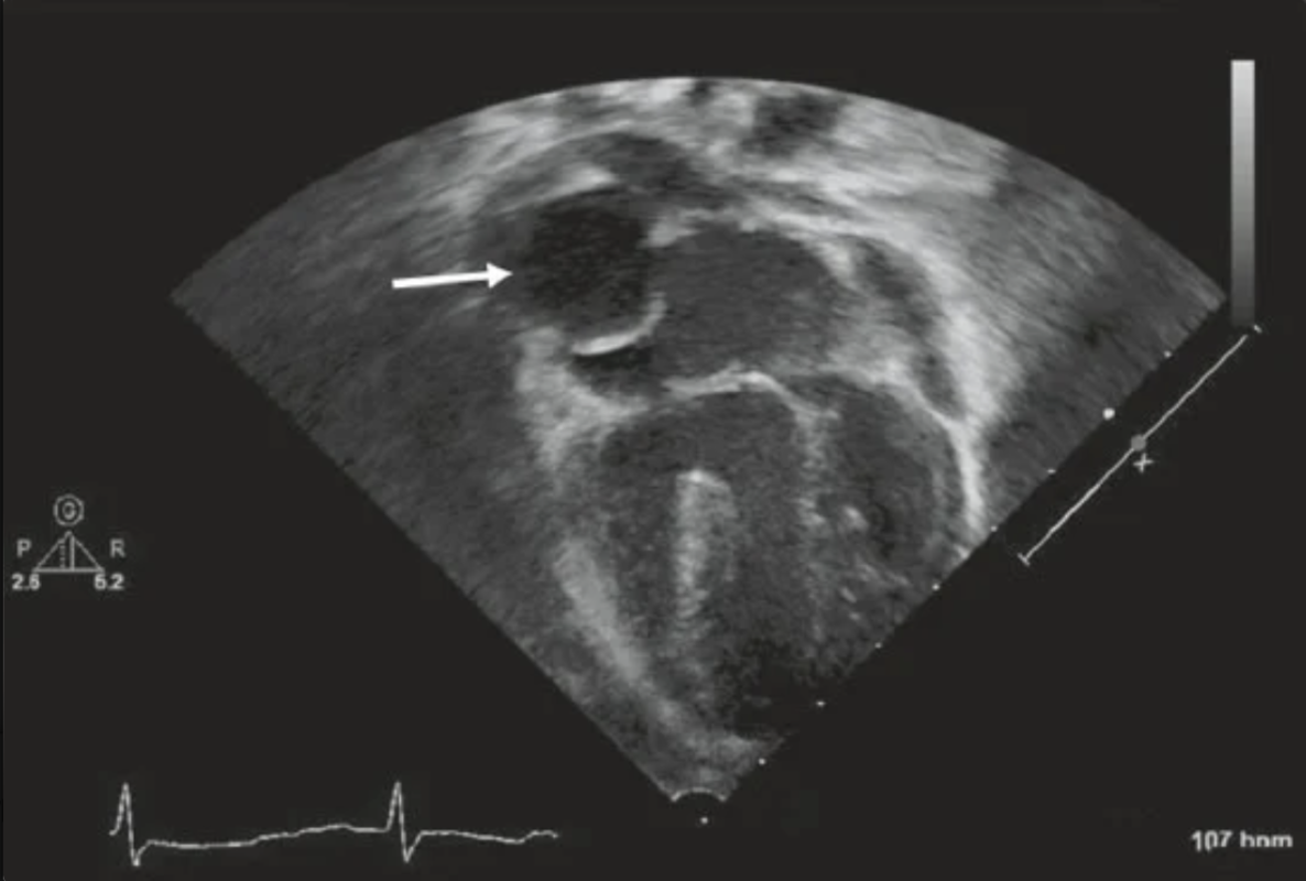 <p>A4C view in a patient with tricuspid atresia is obtained following surgical palliation. The structure adjacent to the arrow is…</p>