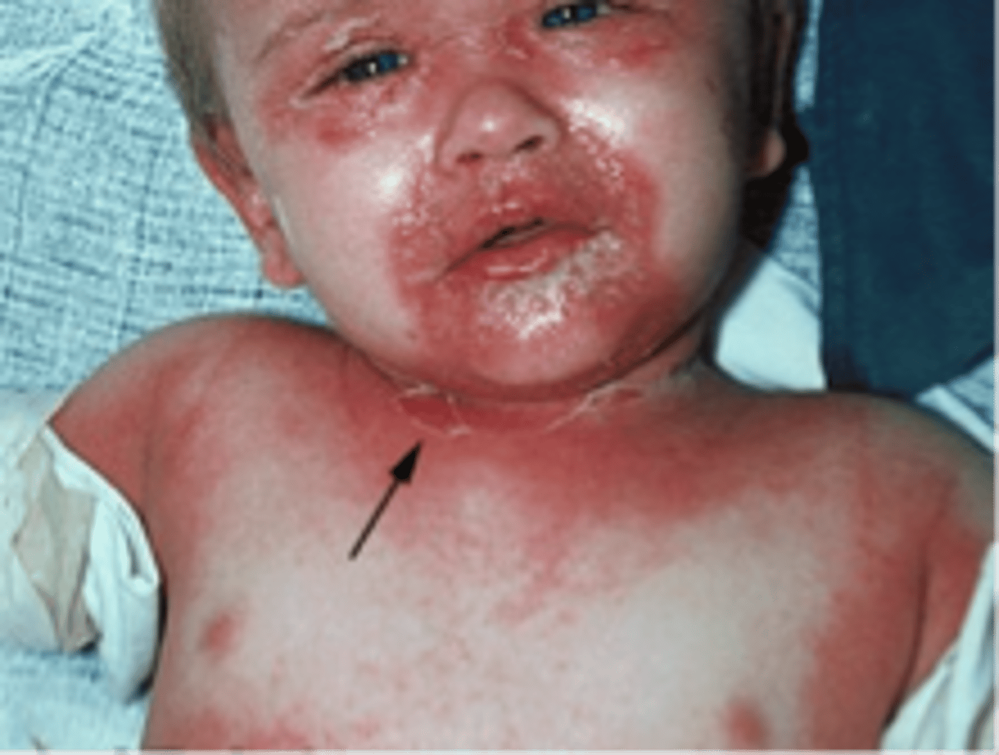 <p>It is dependent on the organism. IV clindamycin, Clindamycin and cefazolin or nafcillin or clindamycin and vancomycin, acetaminophen</p>