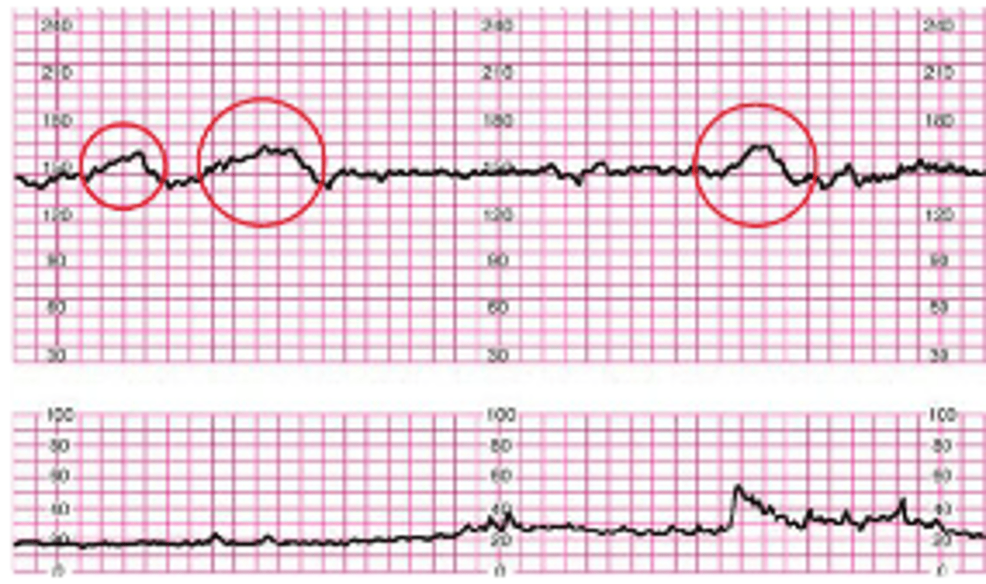 <p>2 accelerations, at least 15 bpm above baseline, for at least 15 seconds in 20 minutes</p>