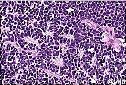 <p>Retinoblastoma</p><p>M/P: The tumor is formed of undifferentiated retinal cells; that show characteristic rosettes which is of 2 types:</p><p>1.Flexner-Wintersteiner rosettes (around a lumen).</p><p>2.Homer-Wright rosettes (around neuri-fibrillary structure). <strong>Shown n this picture</strong></p>