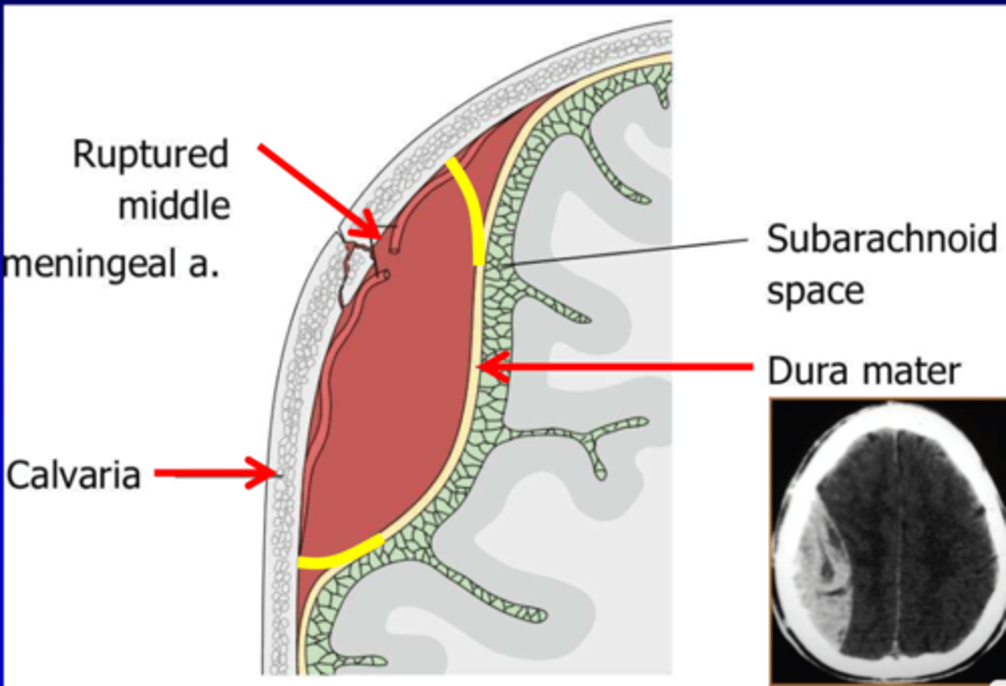 <p>Accumulation of blood in the potential space between the dura &amp; the skull most commonly due to a laceration of the middle meningeal artery (usually from blunt trauma to the head)</p>