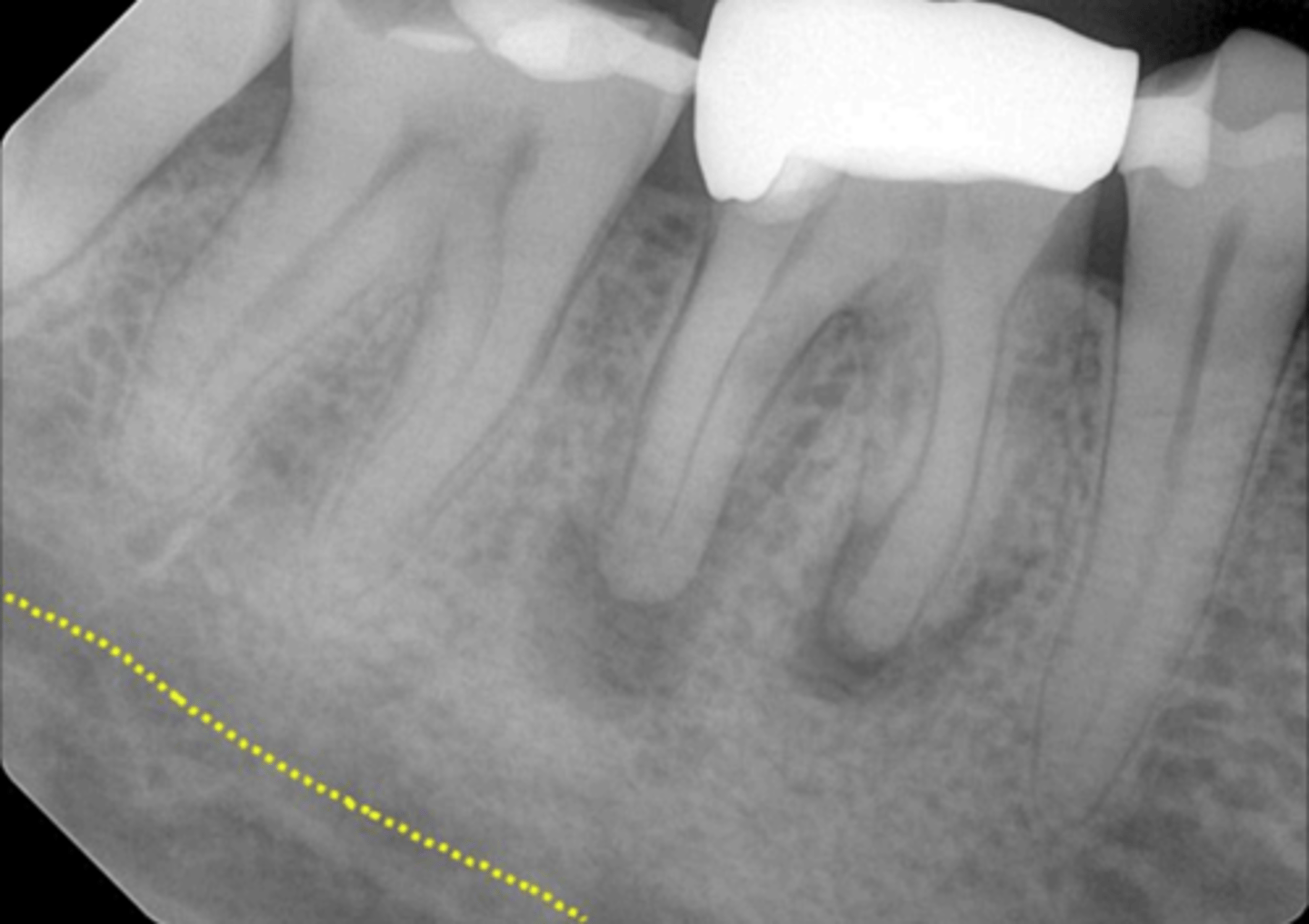<p>What is causing the thick radiolucent line surrounding the dotted line?</p>