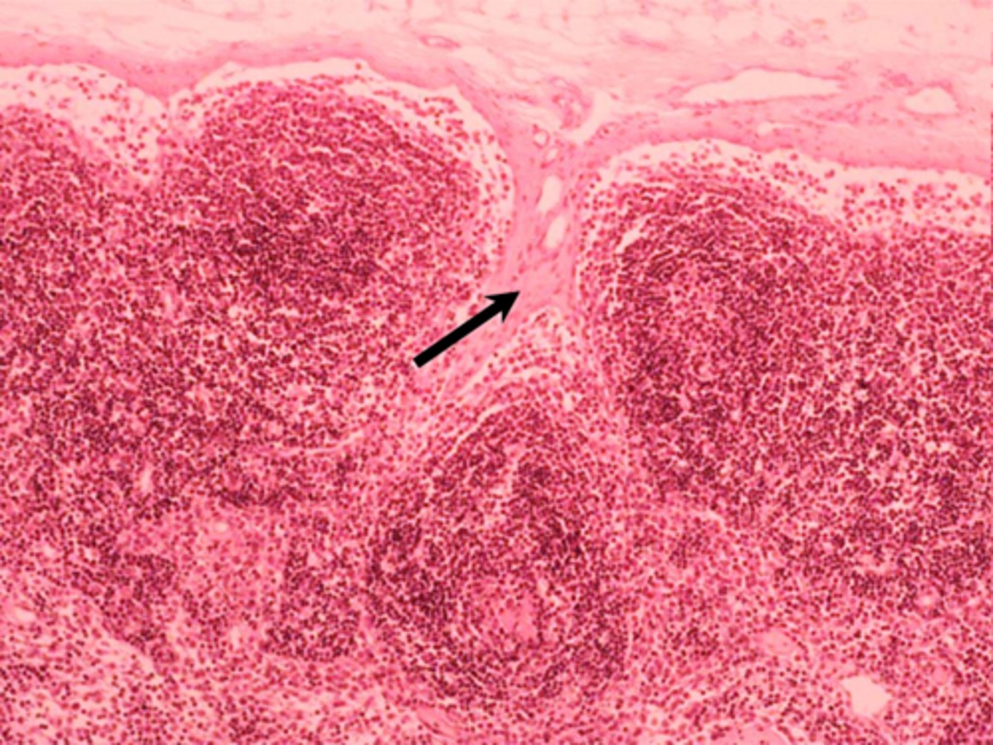 <p>black arrow</p><p>trabecula</p>