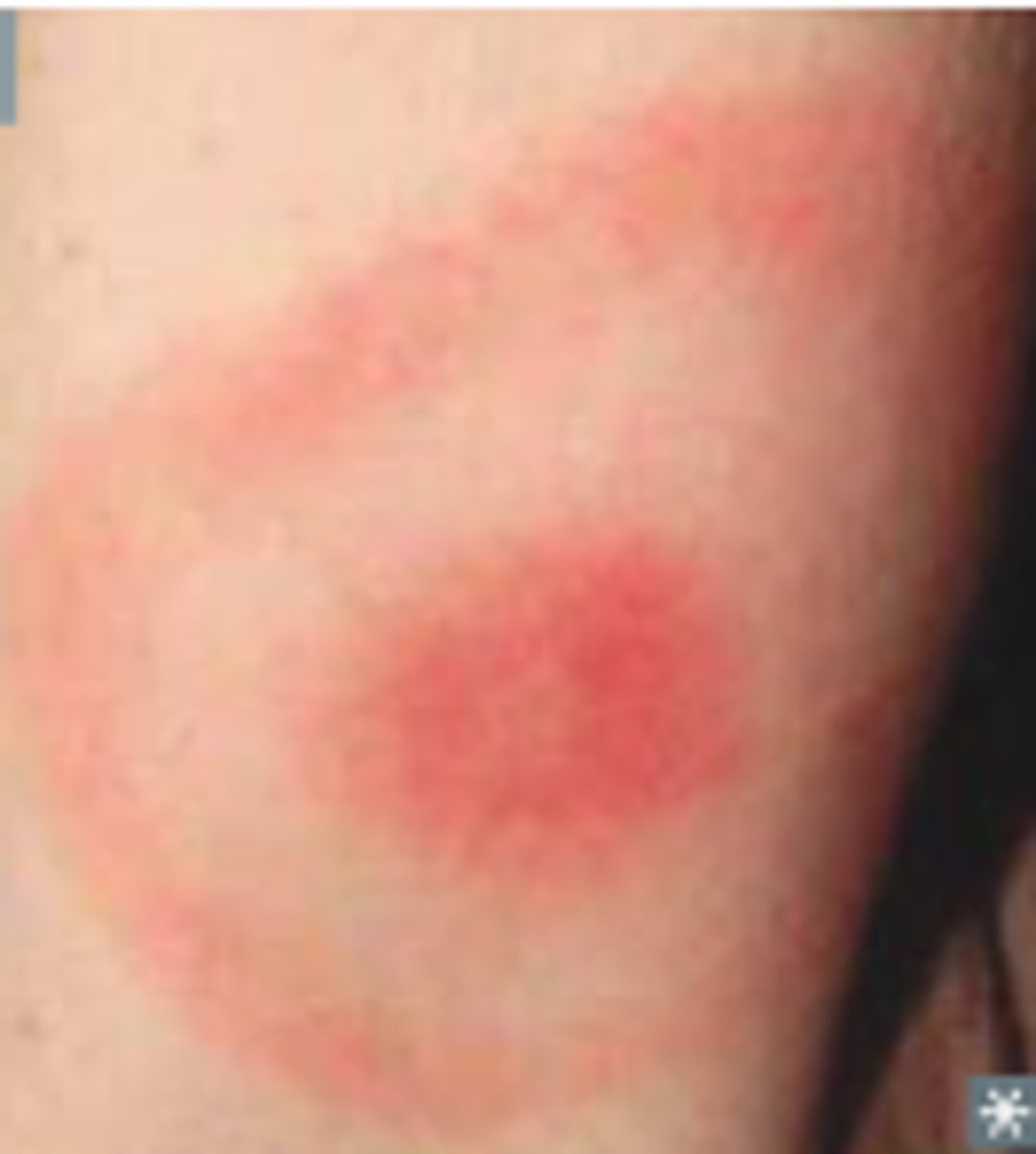 <p>tick exposure, outdoor activities/occupation</p><p>rash not always present, >7 cm</p>