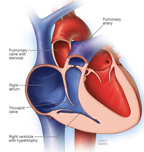 <p><strong><u>Obstructive</u> Disorder</strong></p><ul><li><p class="">Narrowing; Restricted blood flow from the <em><u>right ventricle</u></em> to the <em><u>pulmonary artery</u></em>.</p></li><li><p class="">Right ventrical hypertrophy—similar to tetralogy of fallot.</p></li><li><p class="">Typically asymptomatic:</p><ul><li><p class="">Failure to Thrive (FTT)</p></li><li><p class="">Faint pulses</p></li><li><p class="">Easy fatigue</p></li><li><p class="">Chest pain</p></li></ul></li></ul><p></p>