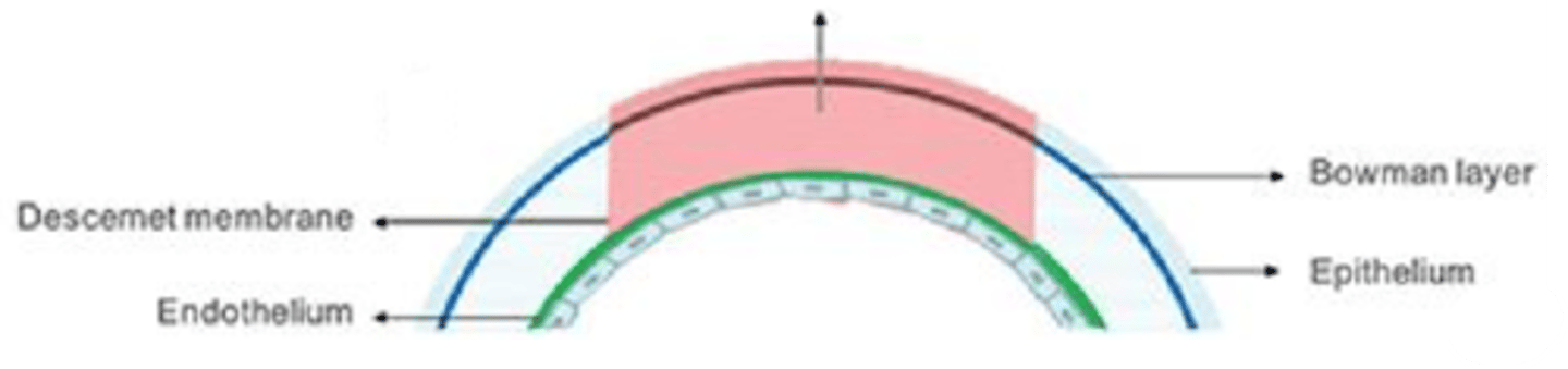 <p>What is a deep anterior lamellar keratoplasty (DALK) and what conditions is it indicated for?</p>