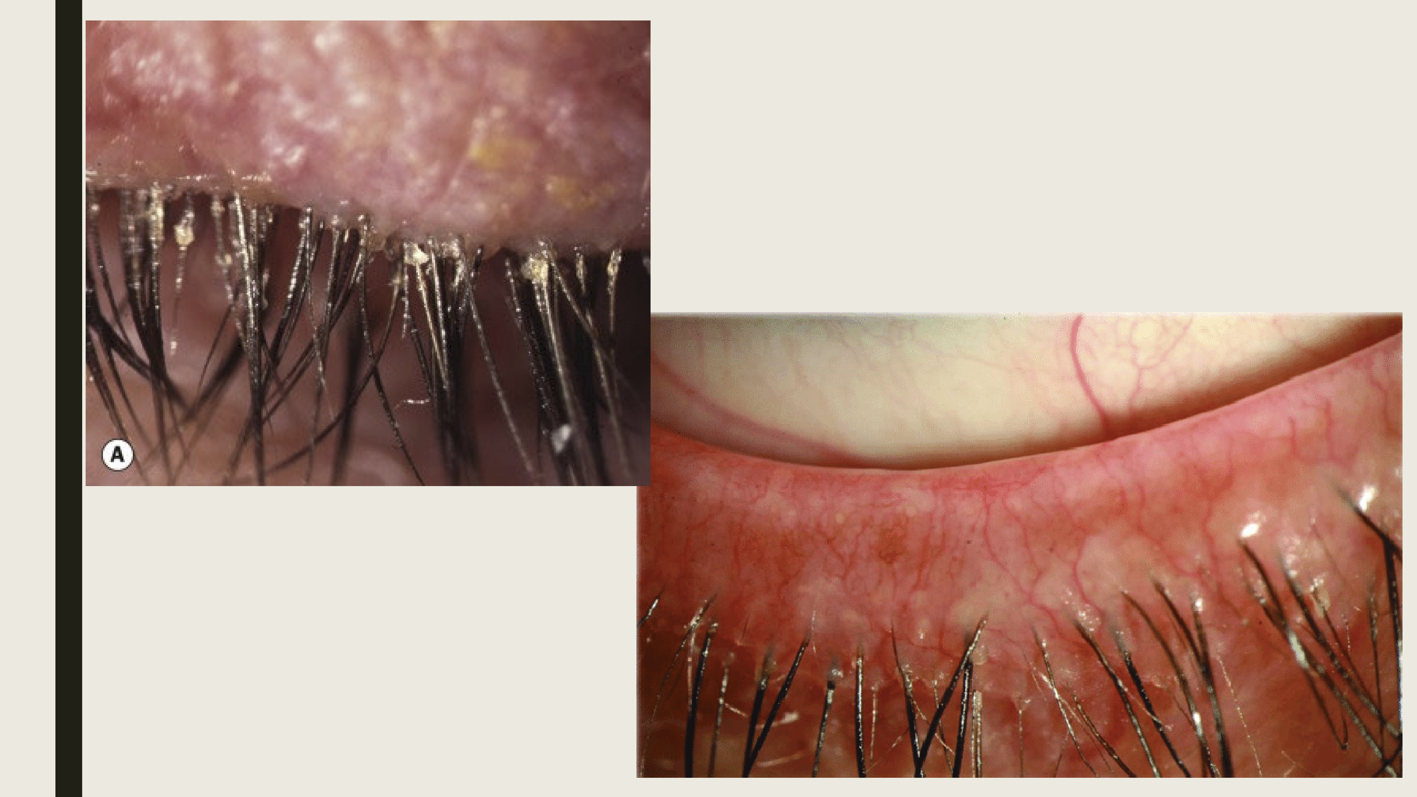 <ul><li><p>Chronic irritation worse in the morning</p></li><li><p>Burning, grittiness, photophobia and crusting </p></li><li><p>Scales around the base of the eyelashes (collarettes) </p></li><li><p>Hyperemic eyelid margin (takes years)</p></li><li><p>If chronic, scarring and hypertrophy of the eyelid margin </p><ul><li><p>madarosis, trichiasis, poliosis </p></li></ul></li></ul><p></p>