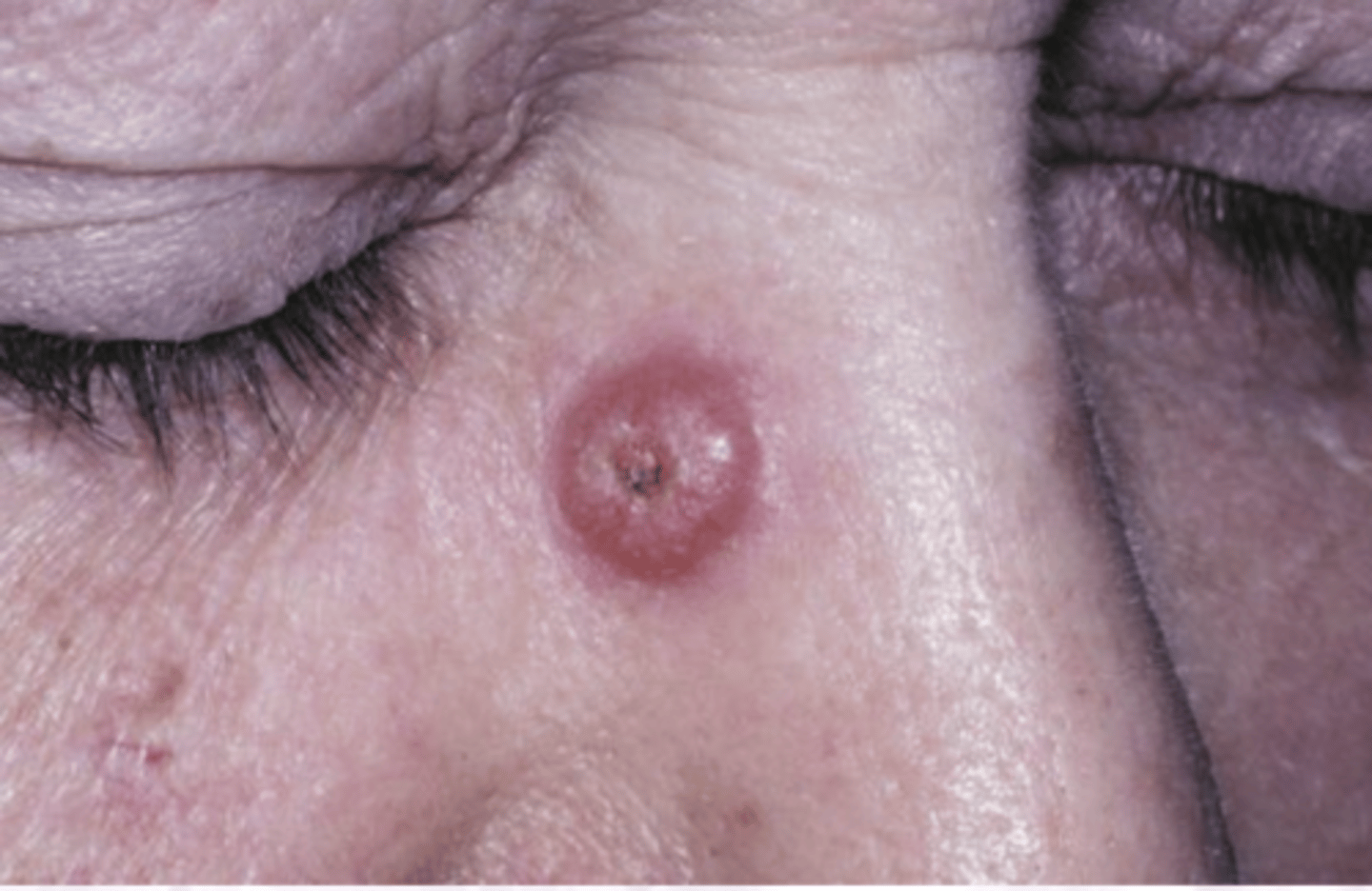 <p>NOT seen intra-orally</p><p>95% are solitary lesions</p><p>Enlarges rapidly</p><p>Can mimic SCCa</p><p>cause: UNKNOWN</p>