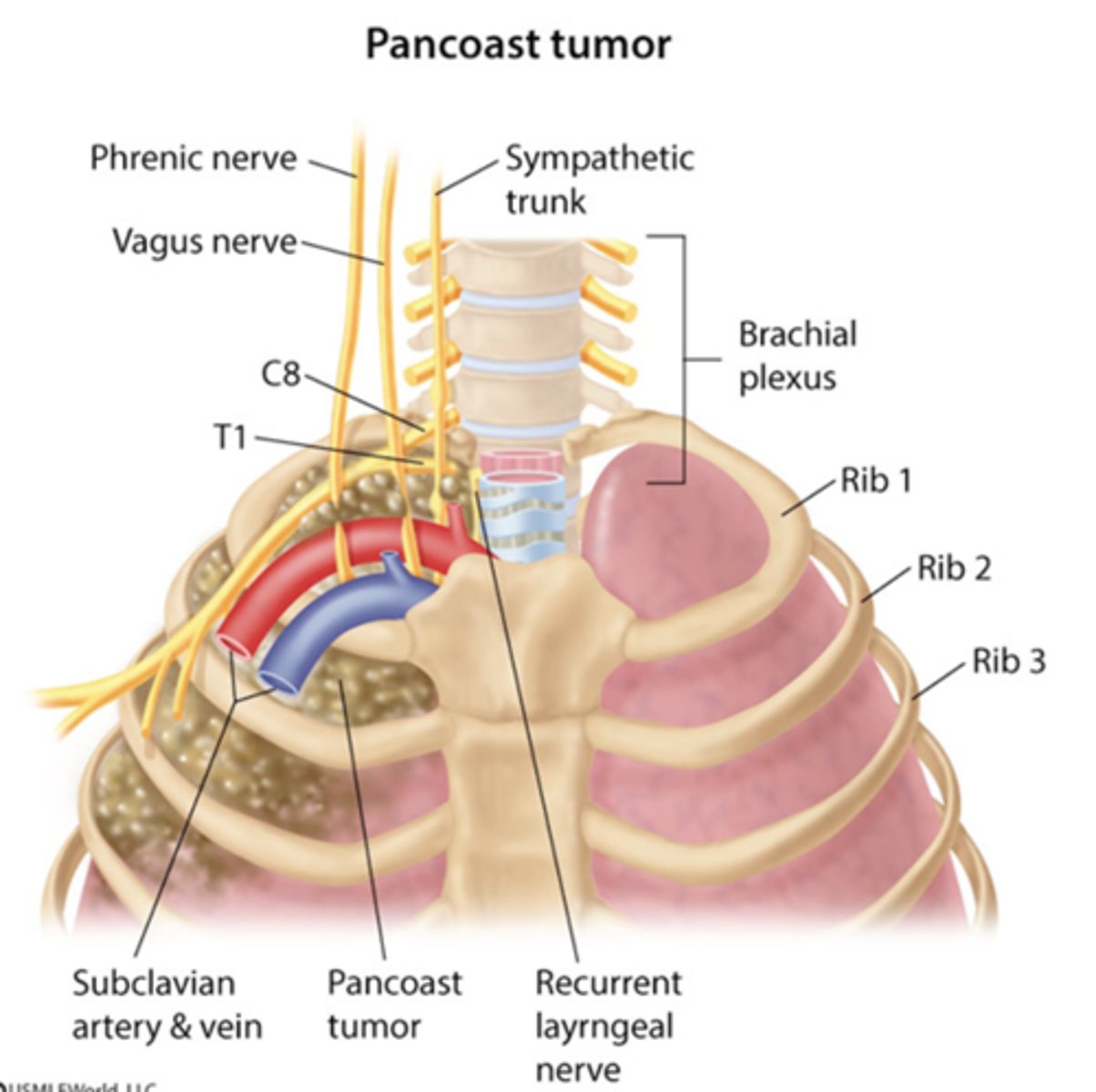 <p>Pancoast tumors (superior pulmonary sulcus tumors)</p><p>- CXR in pts with suspected lung cancer</p>