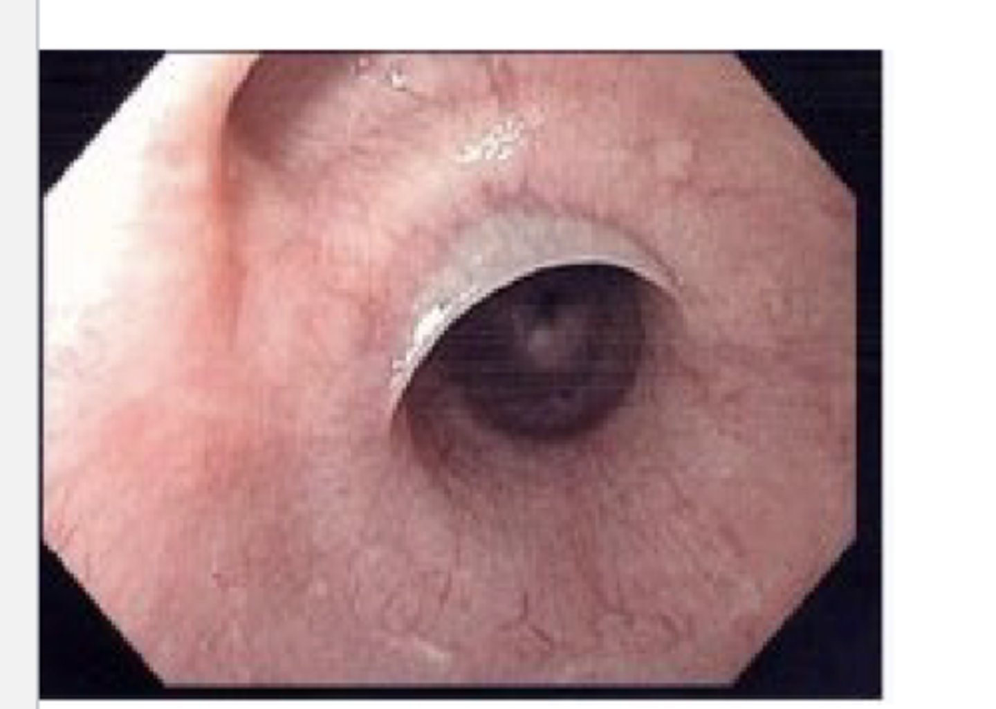 <p>proximal membrane formation</p><p>*occurs in</p><p>-iron deficiency anemia</p><p>-plummer-vinson syndrome</p>