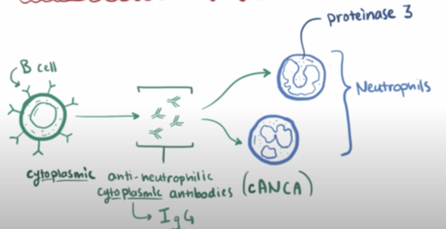 <p>- a disease where a persons b cells targets granules which are released by their neutrophils (granulomatosis) with an autoantibody called c-ANCA</p><p>- this causes free radicals to be released which damages endothelial cells and affects blood flow</p><p>this then blood supply to </p><p>1. nasopharynx - can cause saddle nose deformity</p><p>2. lungs - can cause difficulty breathing, and ulcers -> causing bloody cough</p><p>3. kidneys - decreased urine output, increased blood pressure (because kidneys cant maintain function to decrease BP). Can cause rapidly progressive glomerulonephritis, </p><p>(classic triad of upper respiratory tract, lower respiratory tract and kidneys)</p>