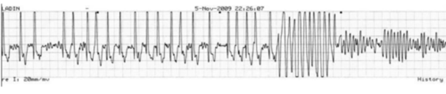<p>Name the arrhythmia.</p>