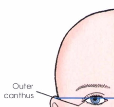 <p><span style="color: oklch(0.3039 0.04 213.68);">Outer canthus</span></p>