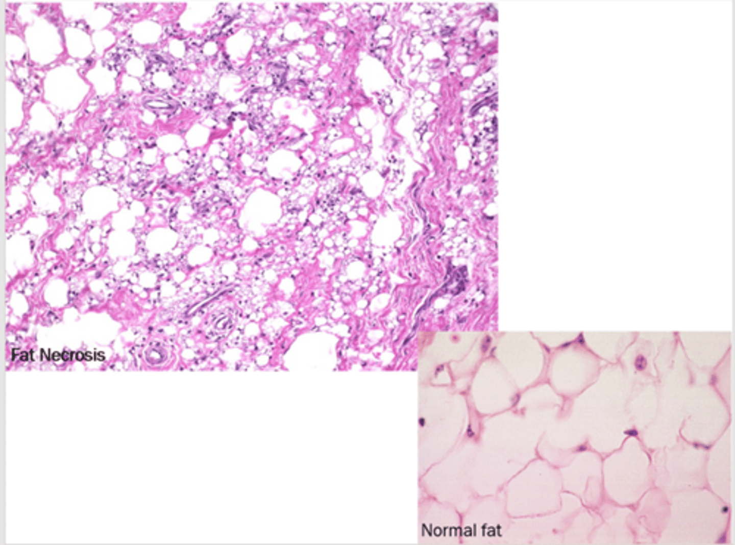 <p>foci of shadowy outlines of necrotic fat cells, basophilic calcium deposits, and inflammatory reaction</p>