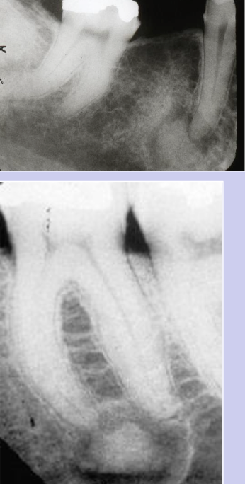 <p>Rim is prominent during the mixed phase</p>