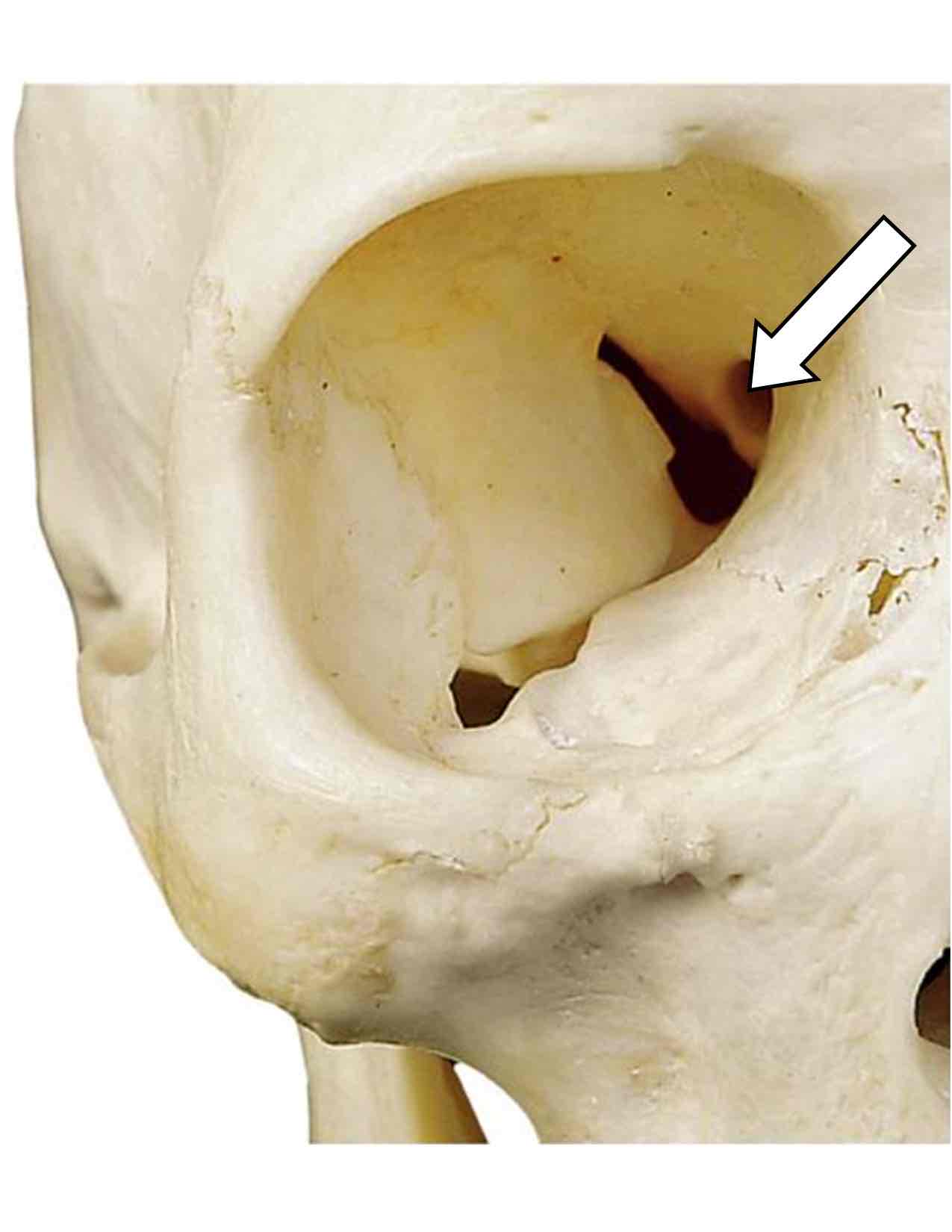 <p>Name the cranial nerve that passes through this hole and its roman numeral</p>