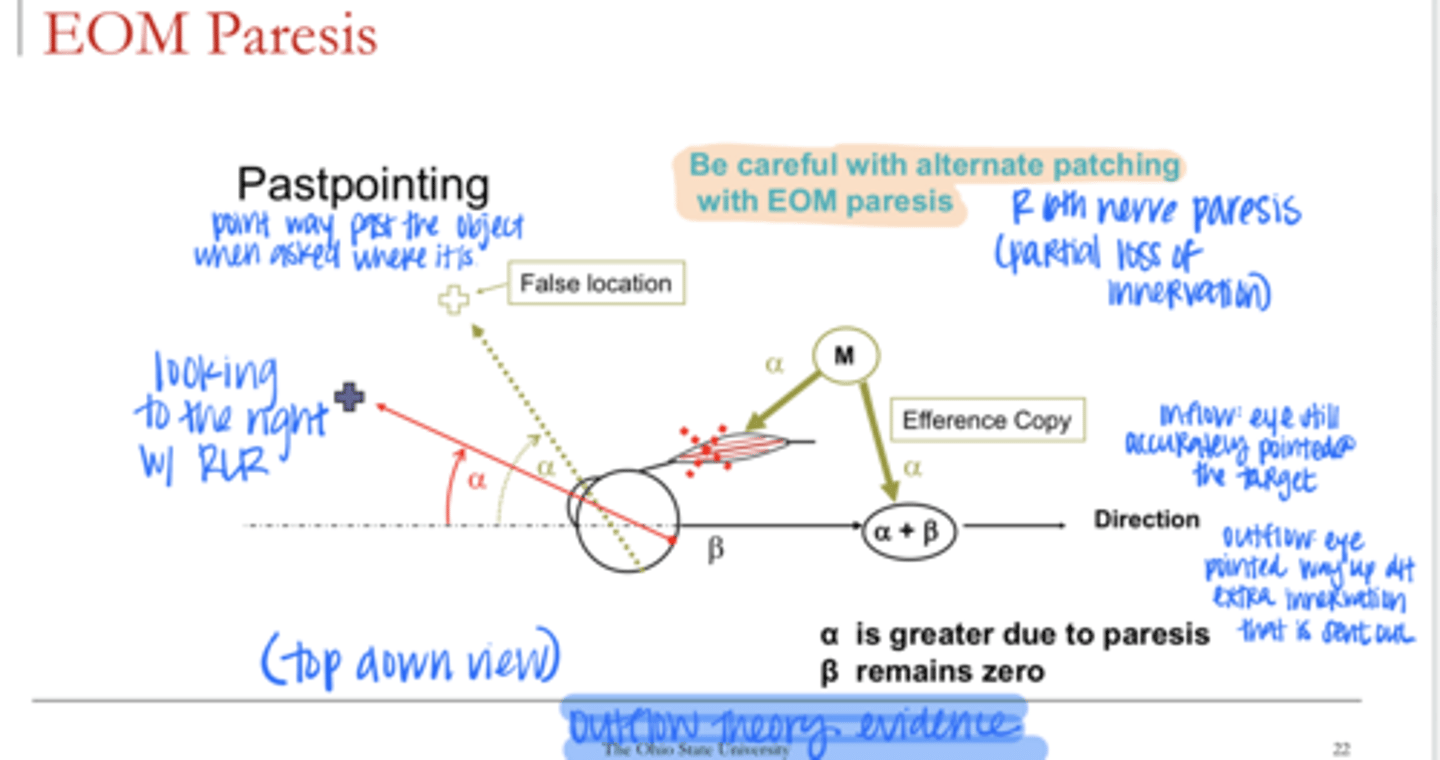 <p>What happens in EOM paresis that is evidence for the outflow theory?</p>