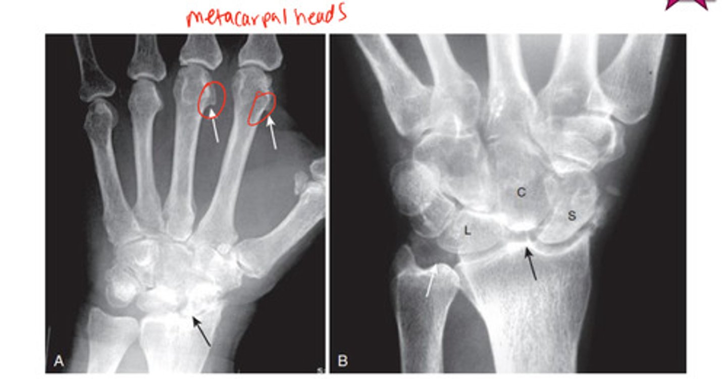 <p>Ca2+ pyrophosphate disease- causing hook shaped deformity along 2nd &amp; 3rd metacarpal head from osteophyte</p>
