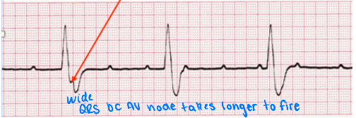 <p>What does this EKG show?</p>