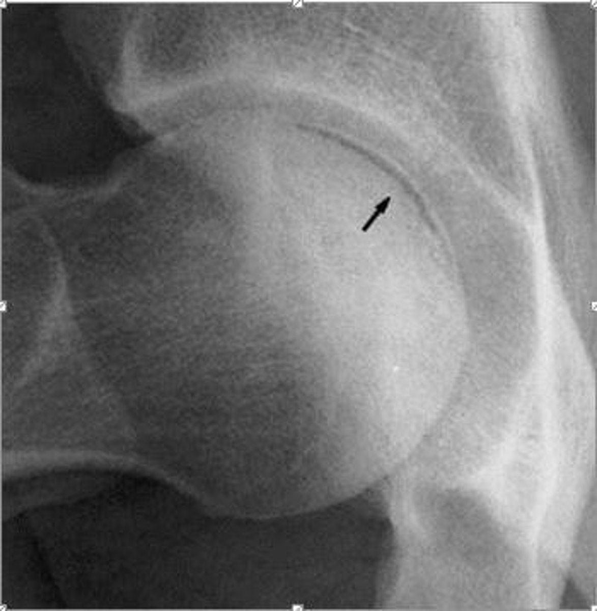 <p>Your pt is a <span style="text-decoration:underline">chronic alcohol abuser</span> with hip pain. What sign might you see if they have <strong><em>avascular necrosis?</em></strong></p><p></p><p>(Radiologist says: <em>"Subarticular lucency of the femoral head")</em></p>