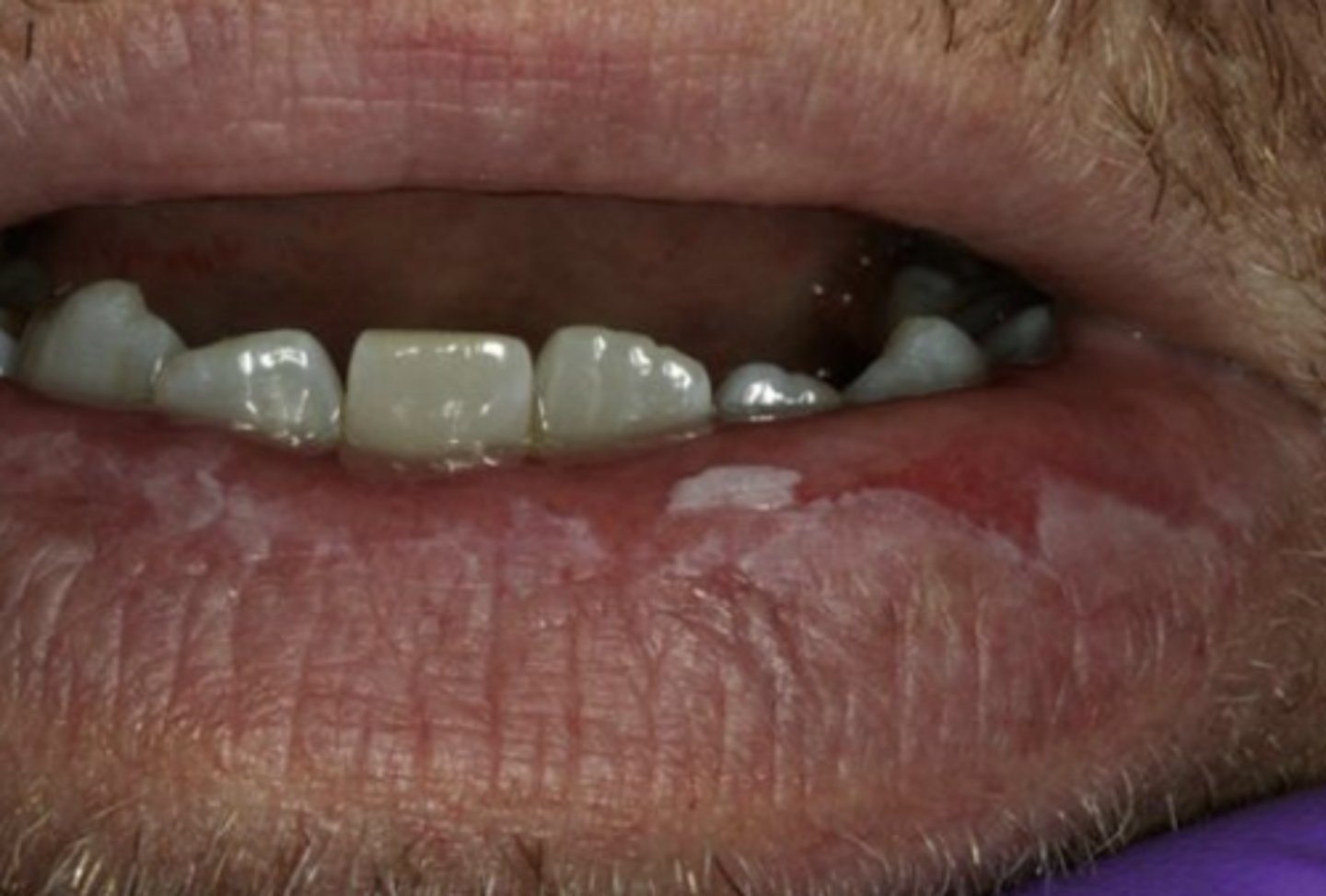 <p>Actinic cheilitis</p>