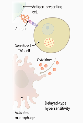 <p><span>type 4 hypersensitivity reaction due to the involvement of CD4</span><sup>+</sup><span> T lymphocytes and CD8</span><sup>+</sup><span> cytotoxic T lymphocytes. </span></p><ul><li><p><span>Type 4 hypersensitivity response is also called a <strong>delayed hypersensitivity </strong>reaction because it usually takes at least <strong>48 hours after exposure to an antigen </strong>for the tissue reaction to show up</span></p></li><li><p>Th1 cells will be sensitized to activate macrophages</p></li></ul><p></p>