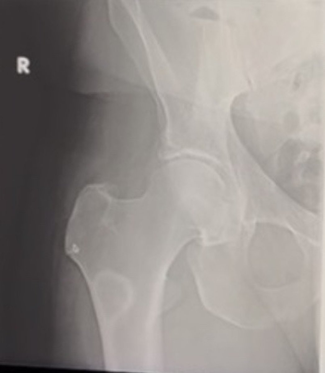 <p>37 year old male with hip pain.</p><p>The most Bely dagnosis is</p>