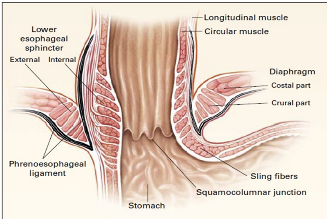 <ul><li><p>Lies left of T11 on horizontal plane passing through tip of xiphoid process</p></li><li><p>Surgeons &amp; endoscopists designate the Z-line a jagged line where mucosa abruptly changes from esophageal to gastric — thus junction</p></li><li><p>Immediately superior, musculature of right crus of diaphragm forming esophageal hiatus functions as an extrinsic physiological inferior esophageal sphincter that contracts/relaxes, along with a variabely thickened muscular coat around cardial orifice of stomach</p><ul><li><p>Radiologic studies shows that food moemntarily stops here with sphincter mechanism preventing reflux of gastric contents into esophagus — when one is not eating, lumen of esophagus is normally collapsed superior to this level to prevent food or stomach juices from regurgitating into esophagus</p></li></ul></li><li><p>This region is very clinically relevant as it is a very common site of tumors/metaplasia — barrett’s esophagus</p></li></ul>