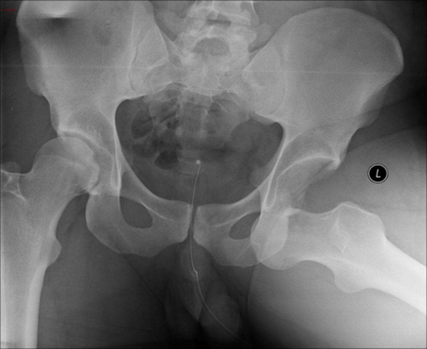 <p>Anterior dislocation- Right<br>Inferior and medial to acetabulum</p>