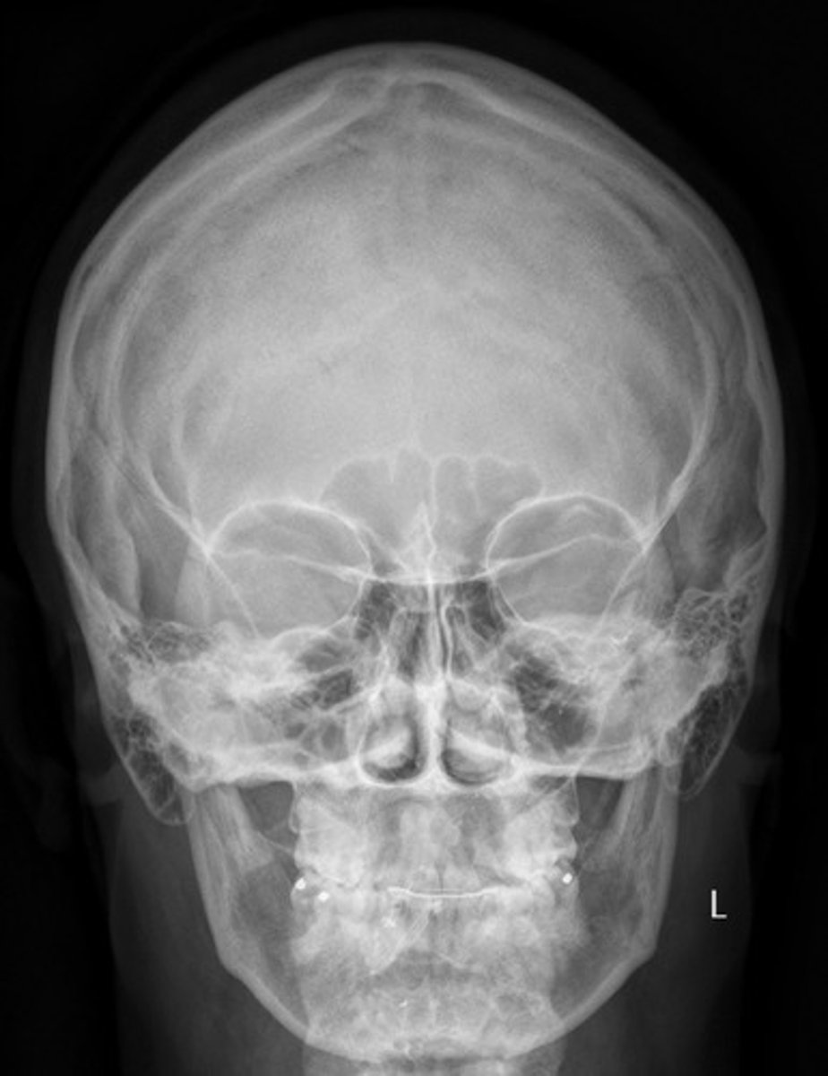 <p>What position/projection? (patient is facing the upright bucky?)</p>