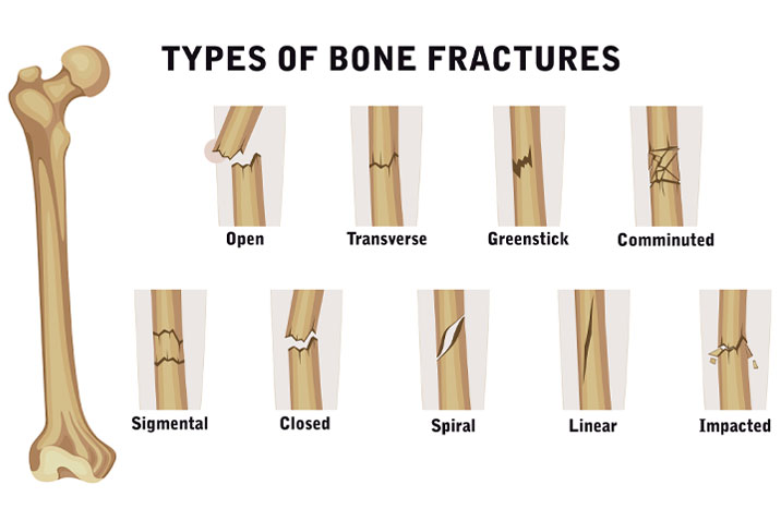 What are Fractures?