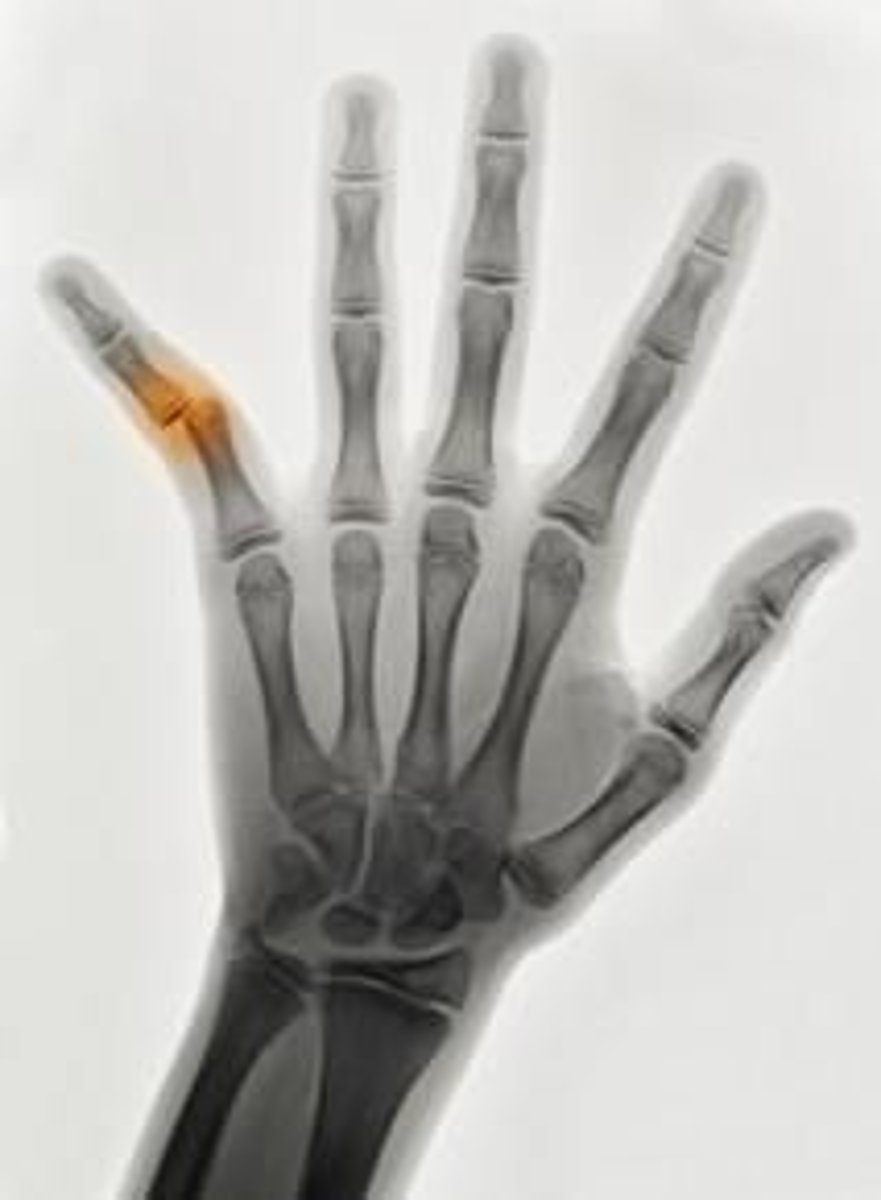 <p>compete separation of two end joints</p>
