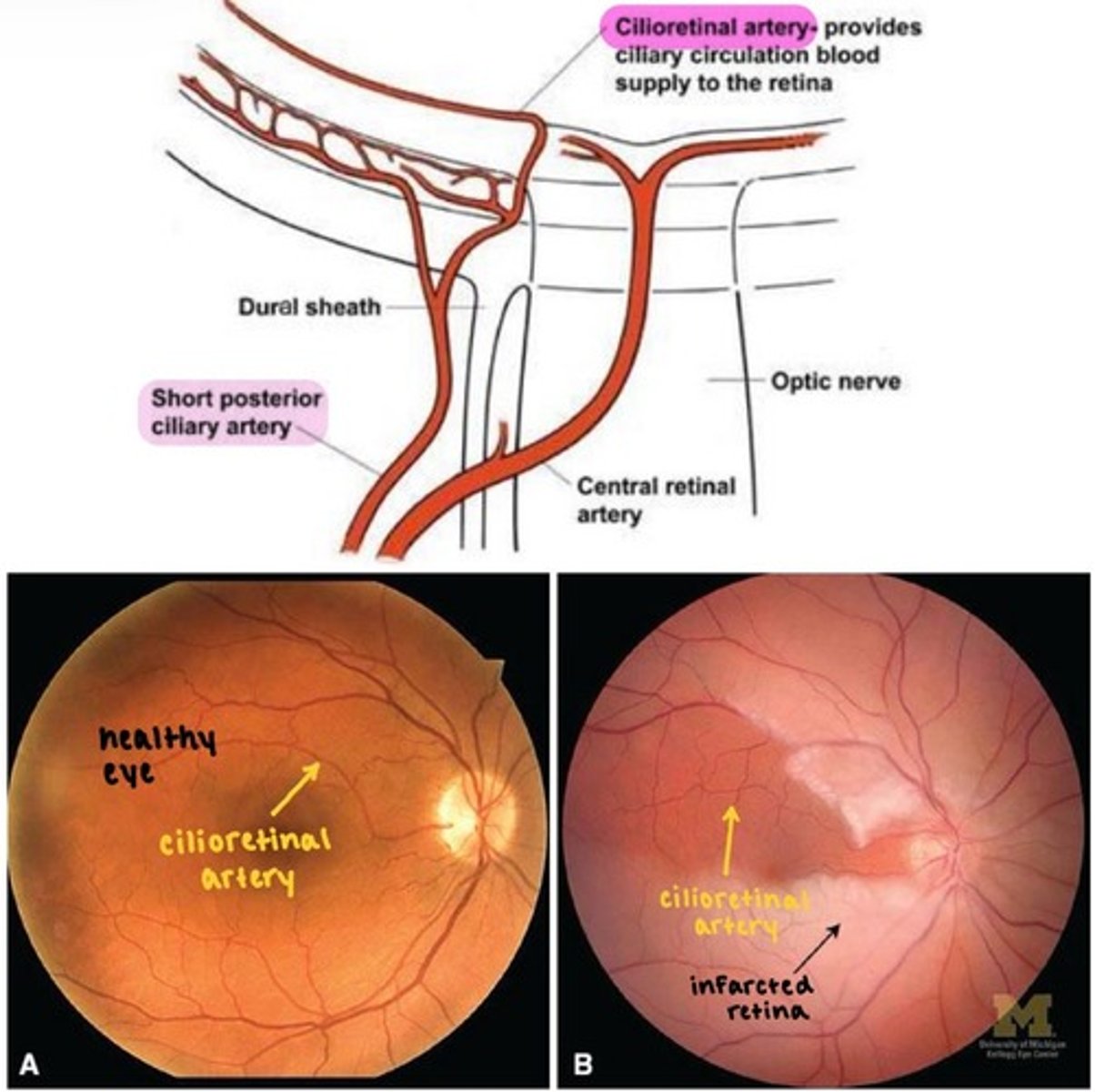 <p>comes out of the temporal aspect of the optic nerve head and supplies the <strong>macula</strong>.</p><p></p><p>branches from <strong>short PCAs</strong> (not from CRA)</p><p></p><p><strong>advantageous in cases of CRA occlusion</strong></p><p>→ if there is CRAO, some blood flow to the macula is preserved via cilioretinal arteries.</p>