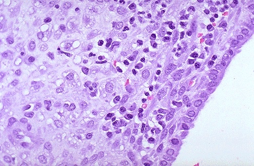<p>Type of cells that are typically present in the inflammatory infiltrate of chronic inflammation.</p><p>In chronic endometritis (picture), which mononuclear cells are observed in the endometrial stroma?</p><p>Why is chronic inflammation considered more variable and difficult to understand compared to acute inflammation? (Wa ni sa webpath ang answer but textbook)</p>