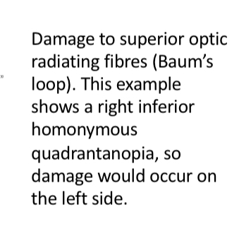 <p>Homonymous inferior quadrontopia</p>