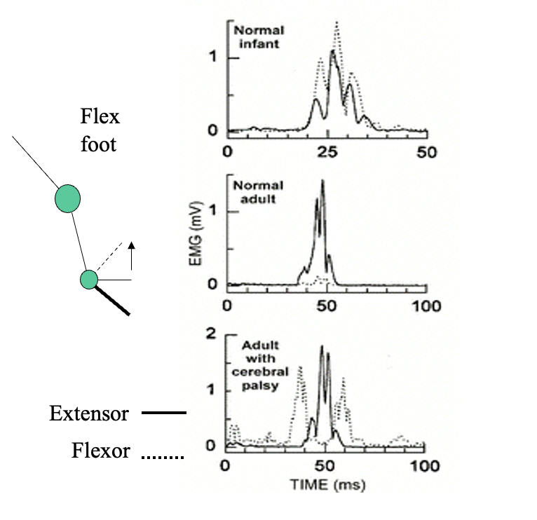 <p>Cerebral palsy→ defects descending systems</p><ul><li><p>which are associated with changes in the regulation of spinal reflexes</p></li></ul><p></p>