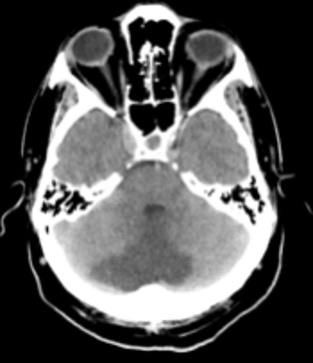 <p>Large cerebellar strokes are at high risk of malignant edema and brainstem compression</p>