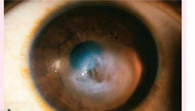 <p> which appears grayish white, may be due to inflammation or an old injury.</p>
