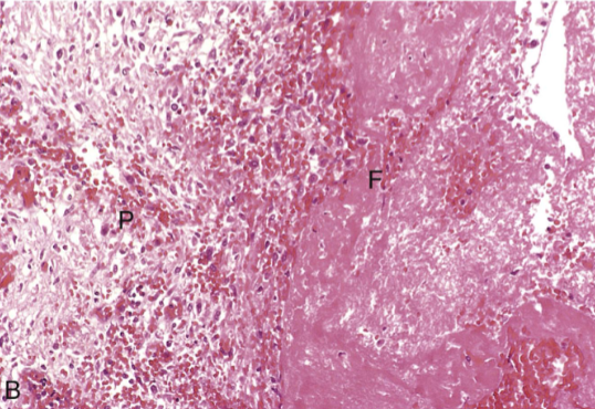 <p>Fibrinous pericarditis (inflammation)</p><p>A pink meshwork of fibrin exudate (F) overlies the pericardial surface (P)</p>