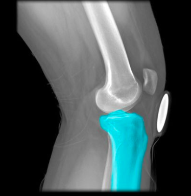 shinbone