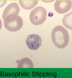 <p>beta thalassaemia</p>